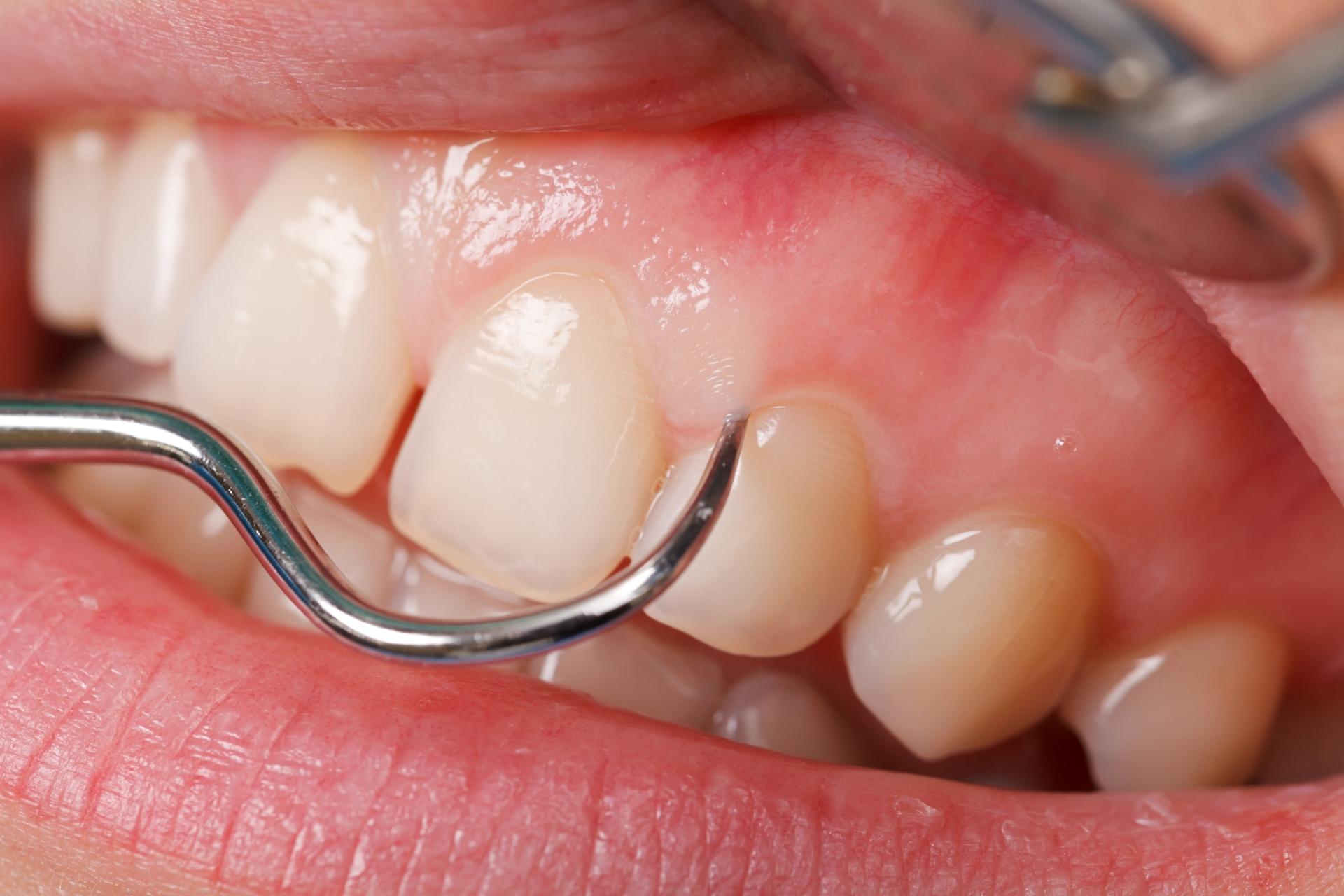 Gum Treatment